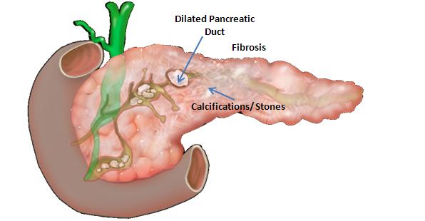 Liver cirrhosis treatment in Pune