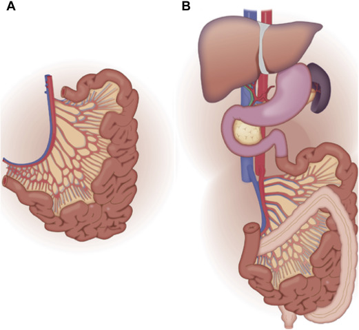 kidney transplant treatment in Pune