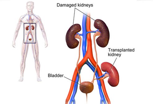 Kidney transplant in Pune