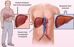 Liver transplant surgeon in Pune