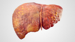 Liver disease treatment in Pune