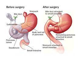 Kidney transplant in Pune