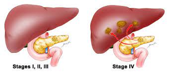 Liver transplant surgeon in Pune