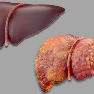 Liver transplant surgeon in Pune