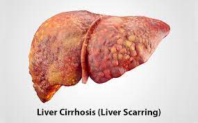 download Liver transplant surgeon in Pune