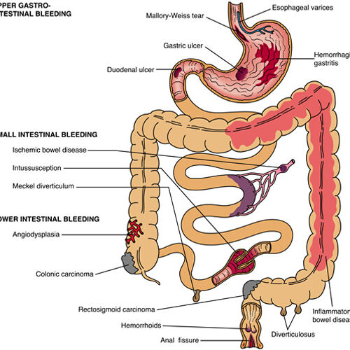 Blood-in-stool-or-malena