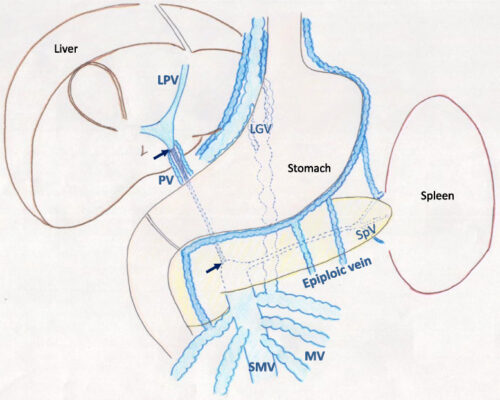Schema-of-extrahepatic-portal-venous-obstruction-Extrahepatic-main-portal-vein-PV-was Schema-of-extrahepatic-portal-venous-obstruction-Extrahepatic-main-portal-vein-PV-was