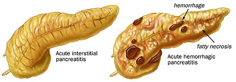 acute pancreatitis acute pancreatitis