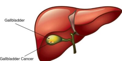 gallbladder-cancer-