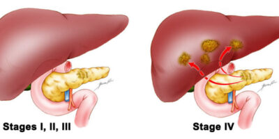 pancreas-stage