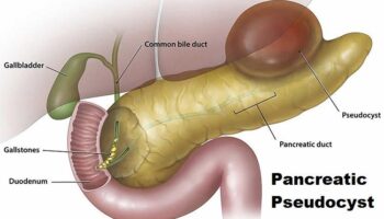 pancreatic-pseudocyst